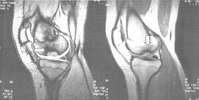 x-ray image of dissected osteochondrosis in the knee joint