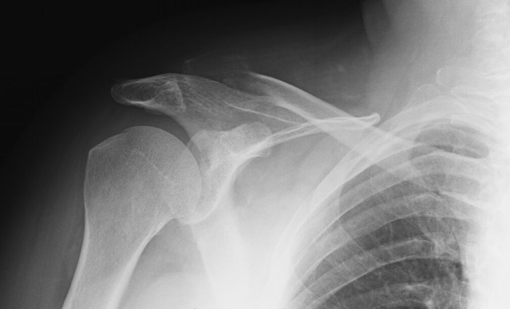 x-ray image of shoulder arthrosis