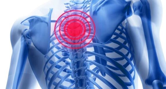 Treatment of osteochondrosis of thoracic spine