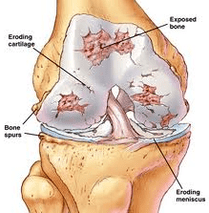 Arthrosis development mechanism